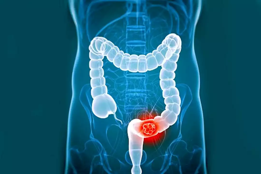 نصائح.. يسبب سرطان الأمعاء … يحذر الطبيب من تناول هذه الأطعمة