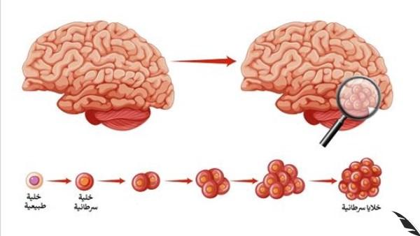 منوعات.. مرض صامت .. تعرف على أعراض سرطان الدماغ