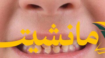 هام للأمهات.. أسباب تصبغ أسنان الأطفال وعلاجه