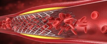 3 علامات تحذيرية كيف تحمي نفسك من مخاطر انسداد الشرايين