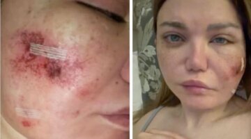 إصابة ياسمين الخطيب أعراض العدوى البكتيرية تثير قلق المتابعين بعد