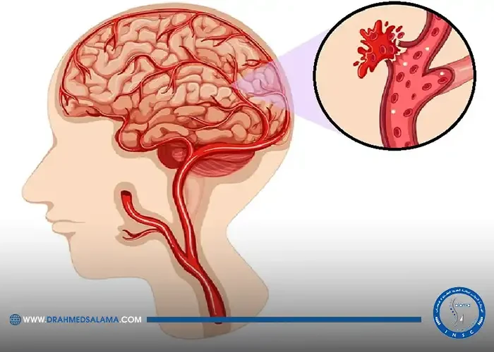علامات تشير لـ نزيف المخ.. منها الصداع المفاجئ والقيء دون سبب وصعوبة الكلام
