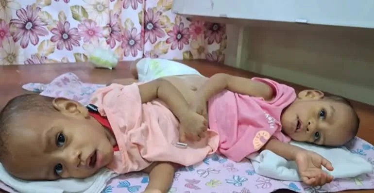 بدء عملية فصل التوأم الملتصق الفيجي في الرياض.. 34 من الكوادر الطبية و15 ساعة متوقعة