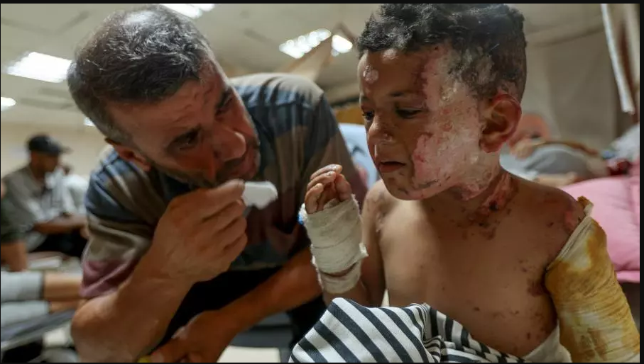 قيود الاحتلال توقف إنتاج أقنعة علاج الحروق في غزة – الشروق أونلاين